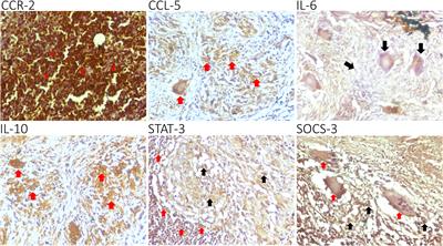 Characterization of chemokine and cytokine expression pattern in tuberculous lymphadenitis patient